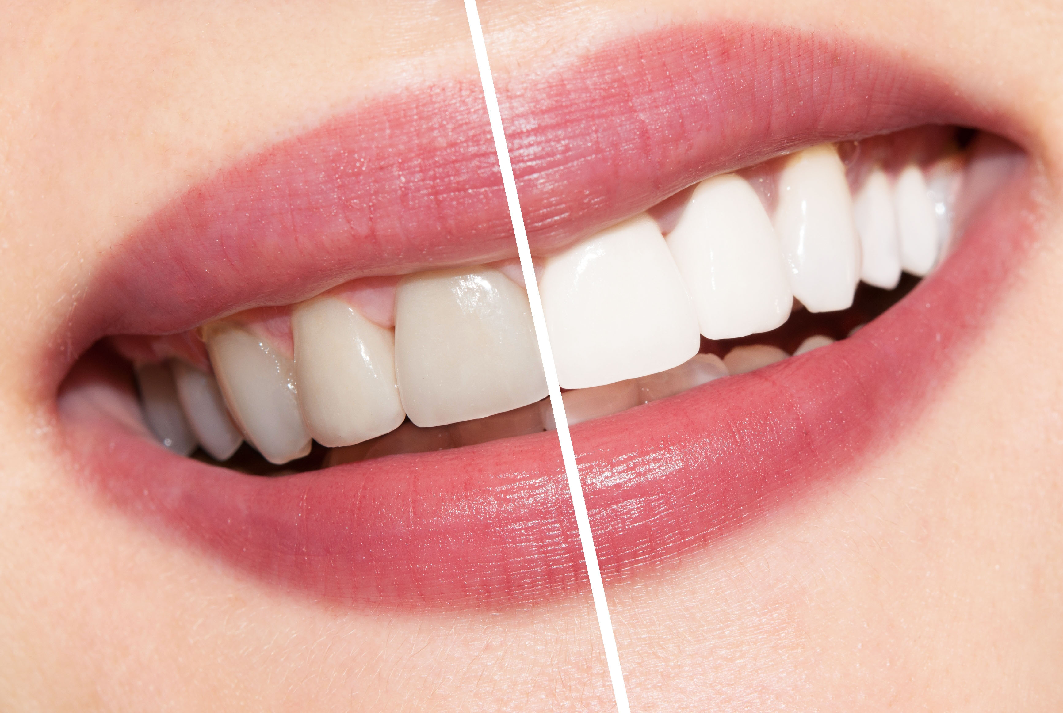 Professional teeth whitening treatment